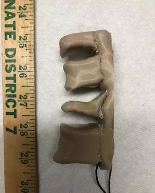 Compression Fracture